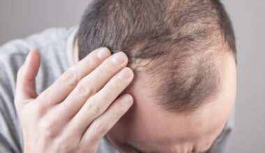 Some achieve dramatic hair regrowth from common arthritis drug: study