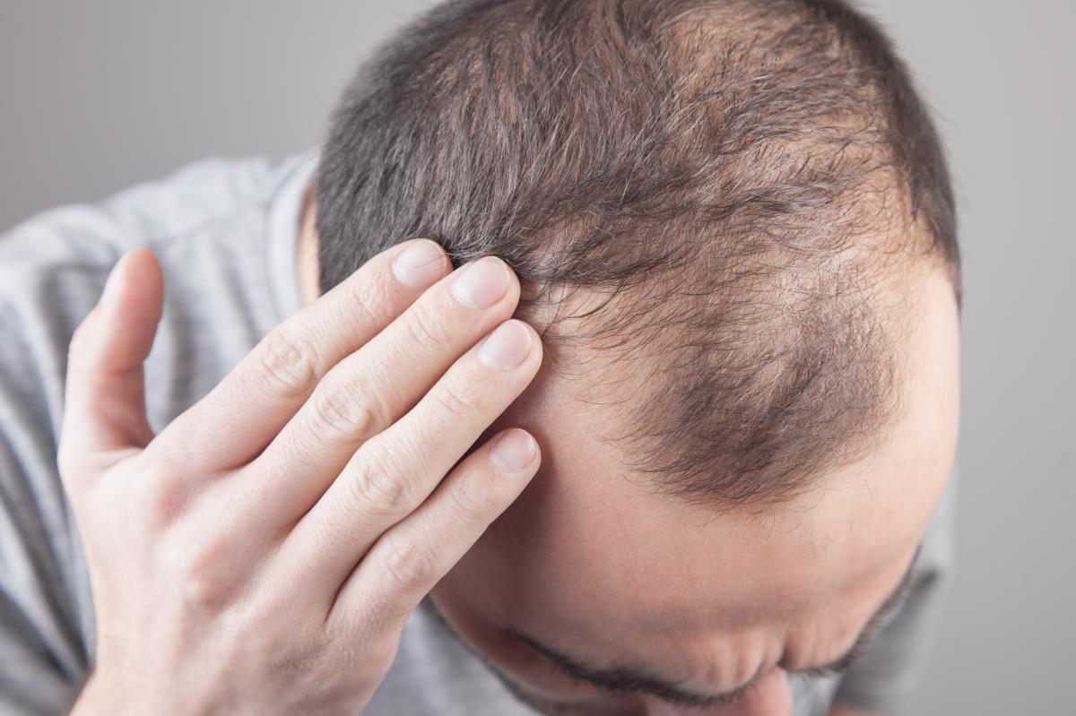 Some achieve dramatic hair regrowth from common arthritis drug: study
