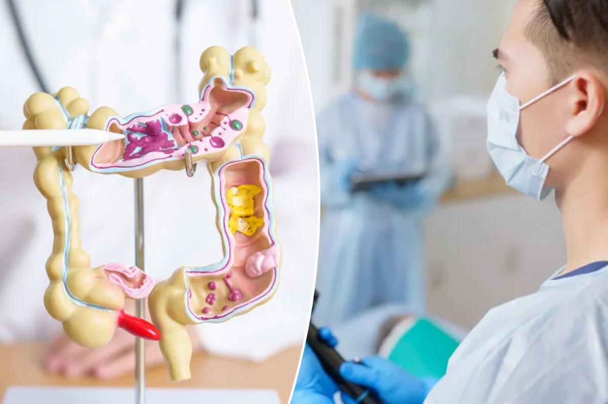 Colon cancer deaths dropped by half for people who did this