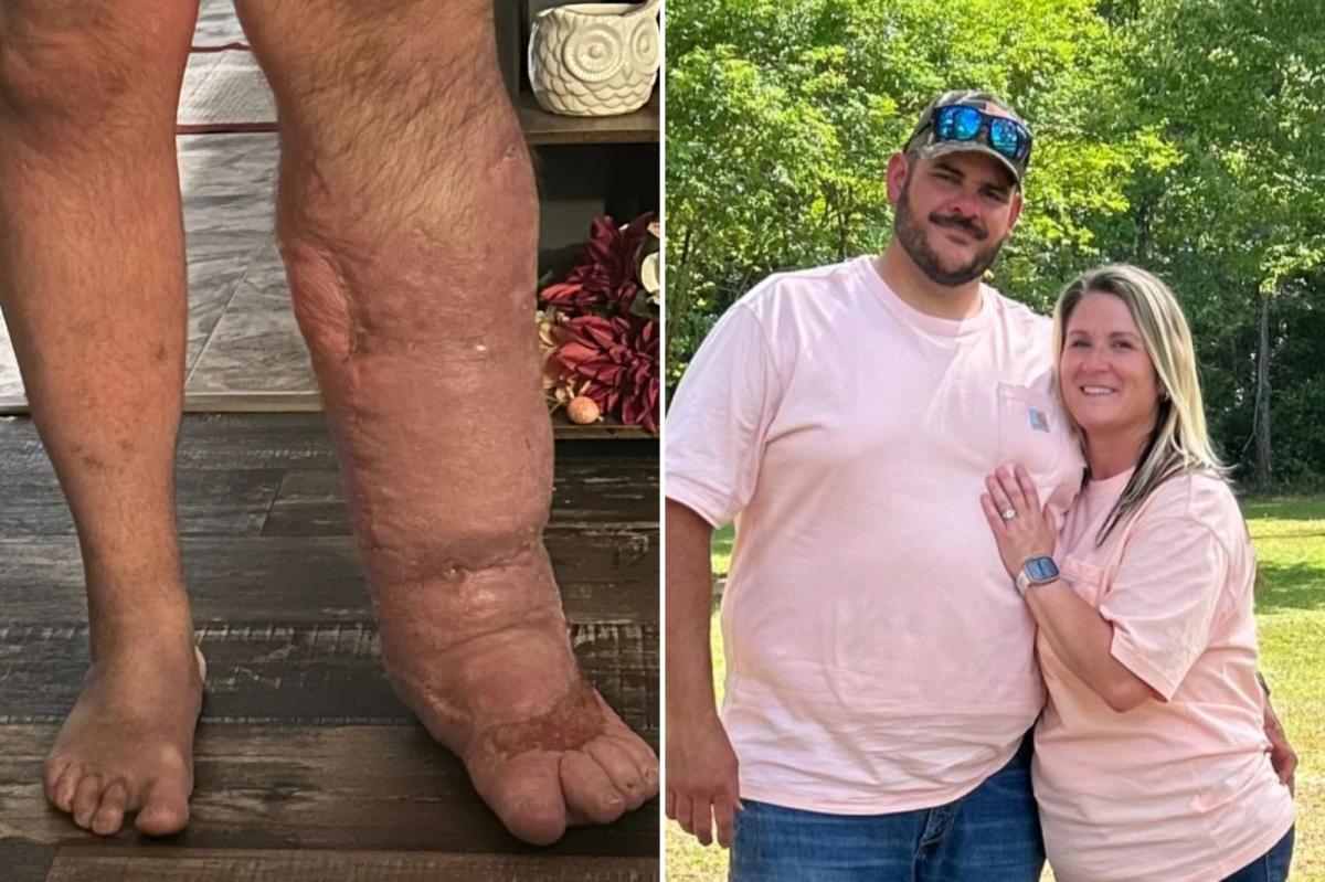 Flesh-eating bacteria caused man's leg to swell to 8 times its size