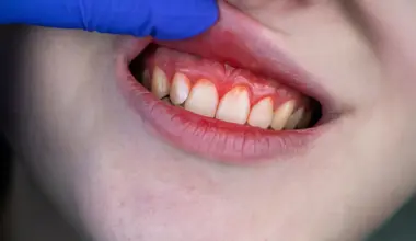 Common supplements rival antibiotics for severe gum disease
