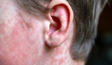 KY Health Department confirms potential measles exposure in Richmond, Olive Hill