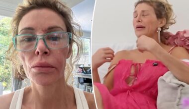 Brandi Glanville breaks down over GoFundMe as she faces ongoing facial disfigurement