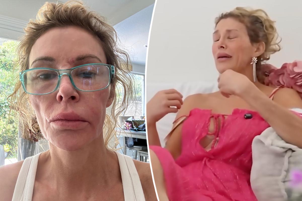 Brandi Glanville breaks down over GoFundMe as she faces ongoing facial disfigurement