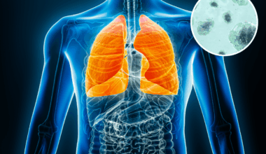 Scientists Studied Lung Cancer Patients—A Troubling Pattern Emerged