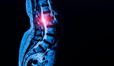 Radiograph X-Ray Back Bone Spinal Pain
