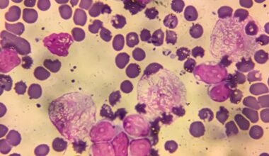 1 in 8 Cancer Cases Worldwide Linked to Infections, Study Finds