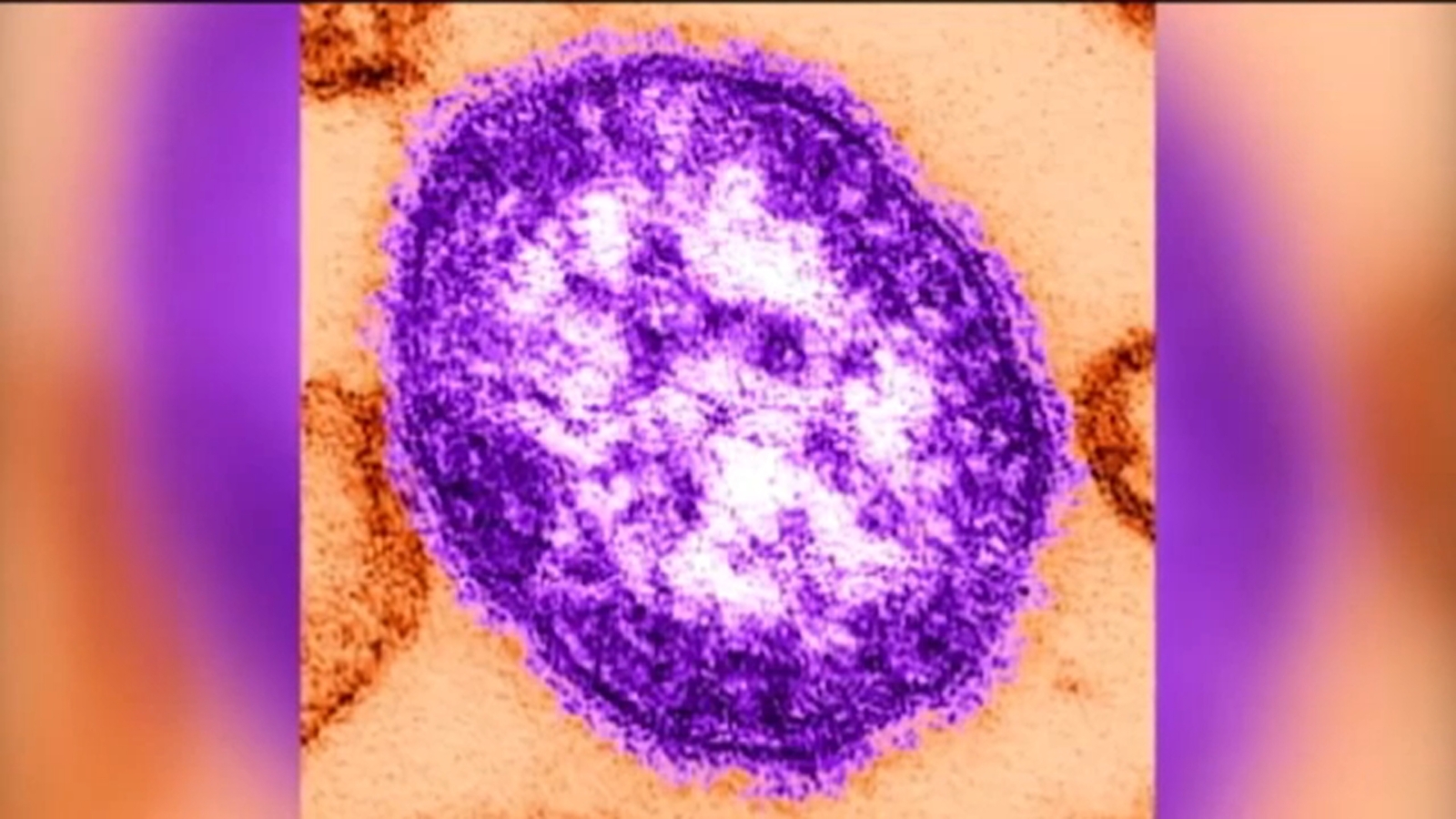Phila. health officials warn of possible measles exposure at Philadelphia International Airport