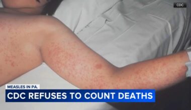 Trumps' new CDC director ordered delay in counting 2 measles-related deaths in Pennsylvania