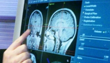 British scientists develop rapid genetic test to diagnose brain cancer