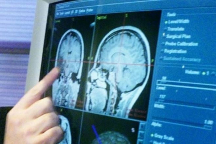 British scientists develop rapid genetic test to diagnose brain cancer