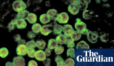North Carolina teenager dies from rare infection caused by brain-eating amoeba | North Carolina