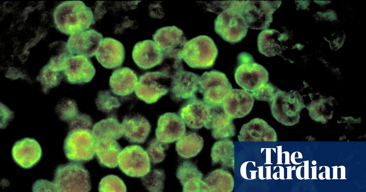 North Carolina teenager dies from rare infection caused by brain-eating amoeba | North Carolina