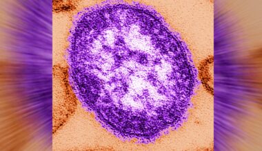 3 new measles cases tied to metro Atlanta daycare, Georgia health officials say