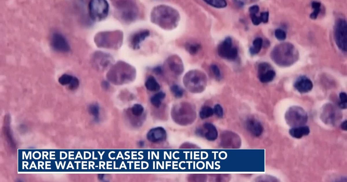 Brain-eating amoeba, flesh-eating bacteria: What NC swimmers should know this Labor Day :: WRAL.com