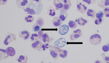 NC teen dies after getting a brain-eating amoeba :: WRAL.com