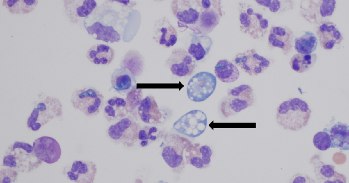 NC teen dies after getting a brain-eating amoeba :: WRAL.com