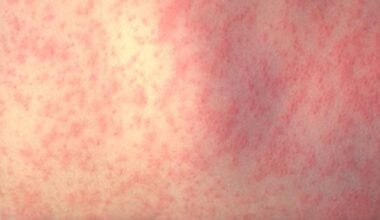 Measles exposure reported at Topeka hospital