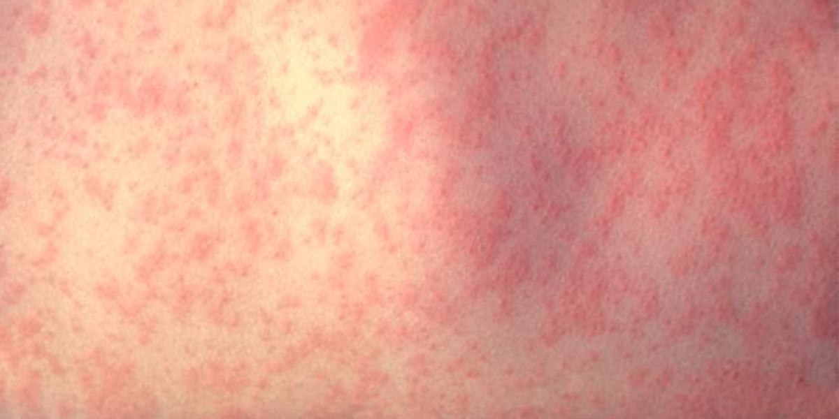 Measles exposure reported at Topeka hospital