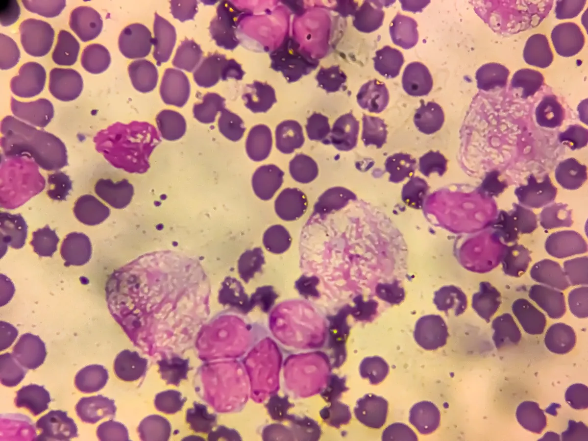Chronic myeloid leukemia cells can be seen in the blood under a microscope.
