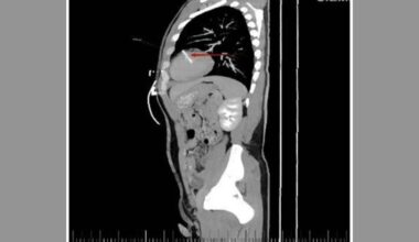 Doctors Scanned This Man's Chest and Found a Sewing Needle in His Heart