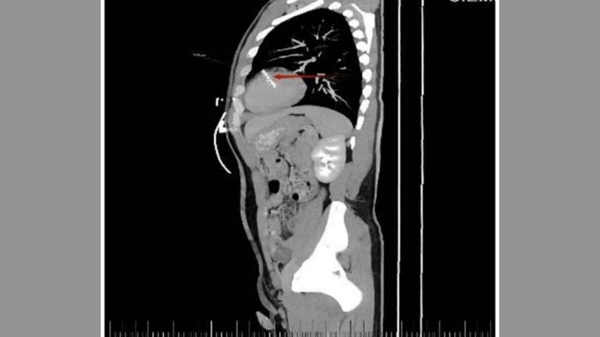 Doctors Scanned This Man's Chest and Found a Sewing Needle in His Heart