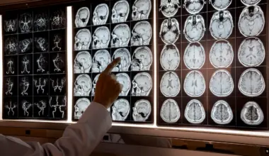Frontotemporal dementia often starts in midlife — and signs are easy to miss