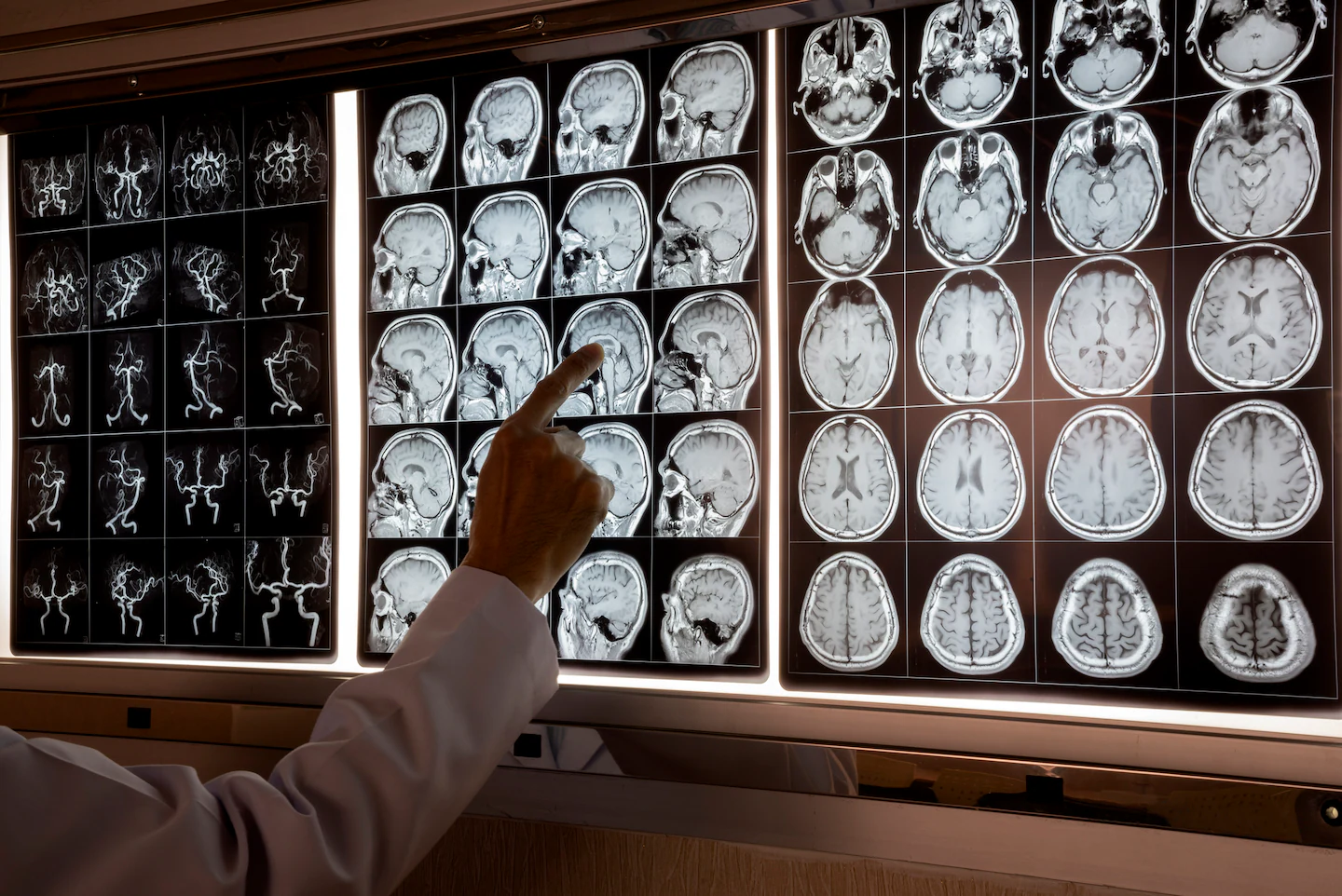 Frontotemporal dementia often starts in midlife — and signs are easy to miss