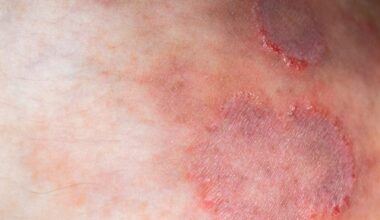 A Drug-Resistant Ringworm Fungus is Surging Across the Globe, Scientists Warn