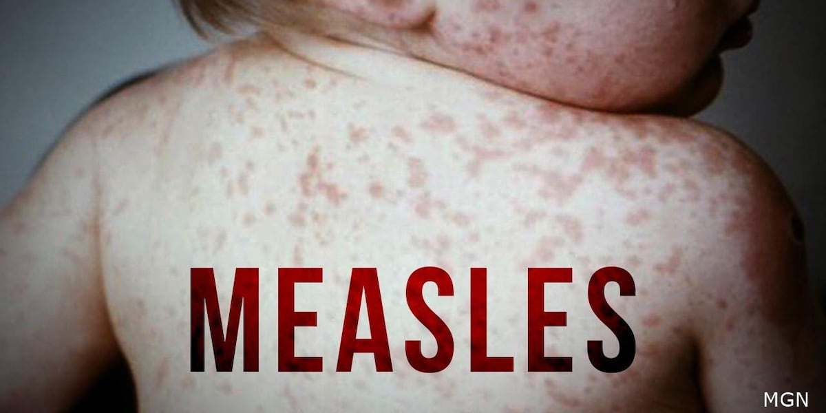 Lewis County investigates ‘confirmed’ case of measles