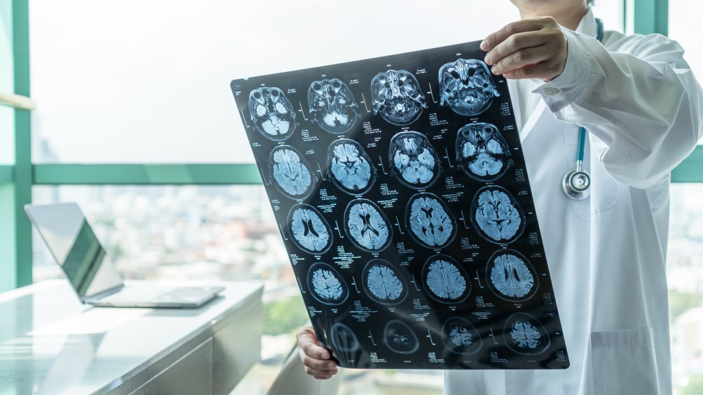 A doctor in a white coat with a stethoscope holding up an MRI film of a brain scan.