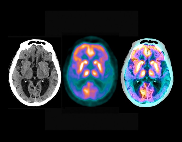 Coloured positron emission tomography and computed tomography scans of a brain affected by Alzheimer's disease.