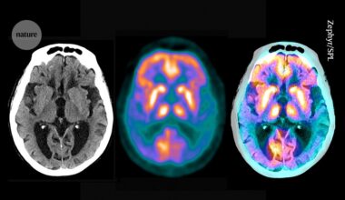 Map of brain ‘microproteins’ could offer new clues to Alzheimer’s disease