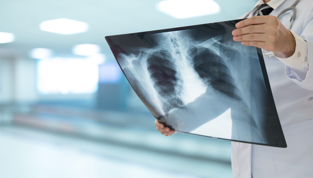 A radiologist diagnosing pneumonia by looking at a chest or lung X-ray image.