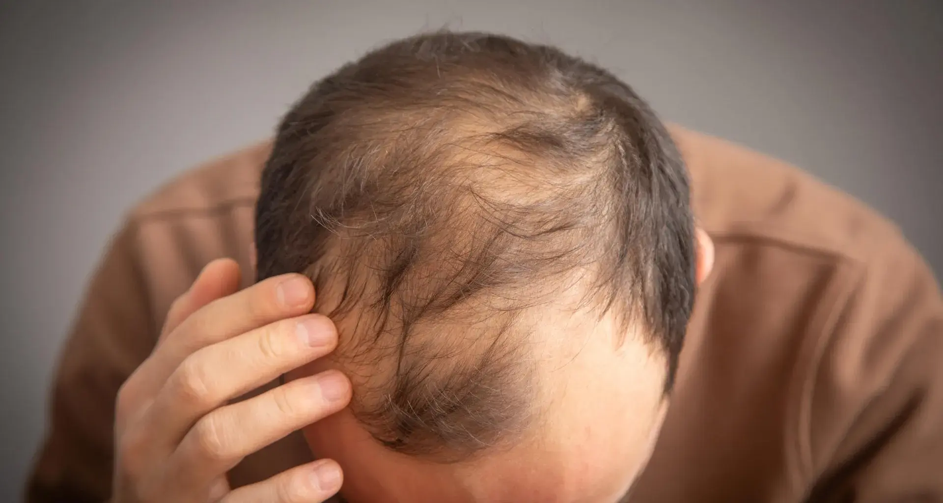 Ozempic and Wegovy may raise hair loss risk in some men
