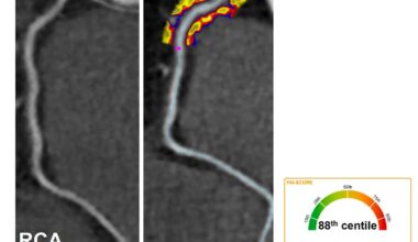 The Coronary Artery Inflammation Controversy