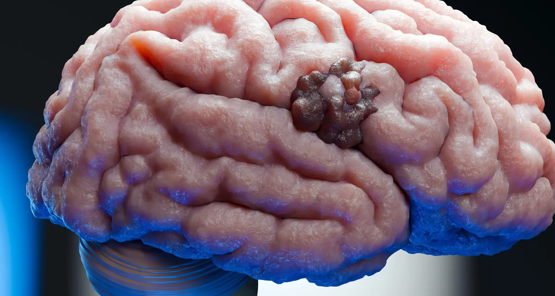 Scientists find a weak spot in one of the deadliest brain cancers - Science Daily