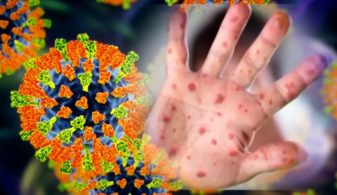 Measles graphic
