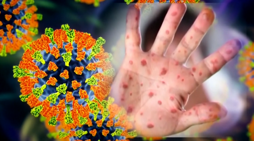 Measles graphic