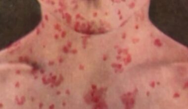 California health department notifies of measles exposure from unvaccinated Amtrak passenger