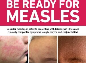 Steuben County Public Health Launches Measles Case Dashboard