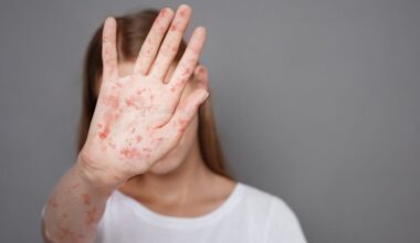 Pennsylvania Officials Report Yet Another Death Linked to Measles as Outbreak Grows