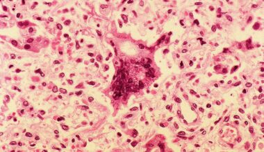 Maine CDC warns of potential measles exposure in Waterville