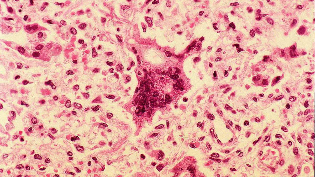 Maine CDC warns of potential measles exposure in Waterville