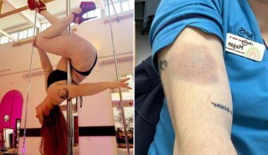 Woman, 28, diagnosed with leukemia after brushing off large, unexplained bruises as pole dancing injuries