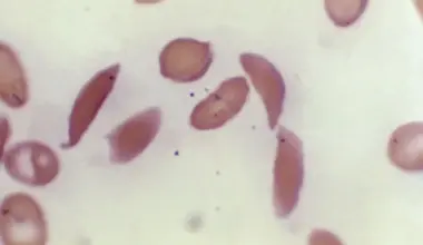Sickle cell gene therapies offer new hope, accessing them is hard
