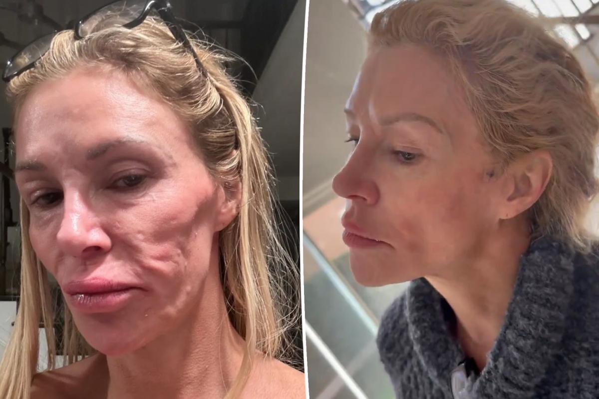 Brandi Glanville to get 'face taken off' for under-skin 'power wash'
