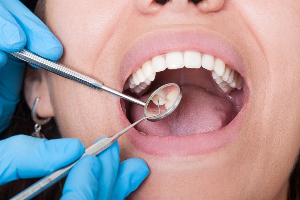 A dentist examining a patient's teeth with a mirror and explorer.