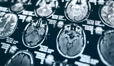 Cheap, Common Drug Linked To Far Lower Dementia Risk—But Only For Some