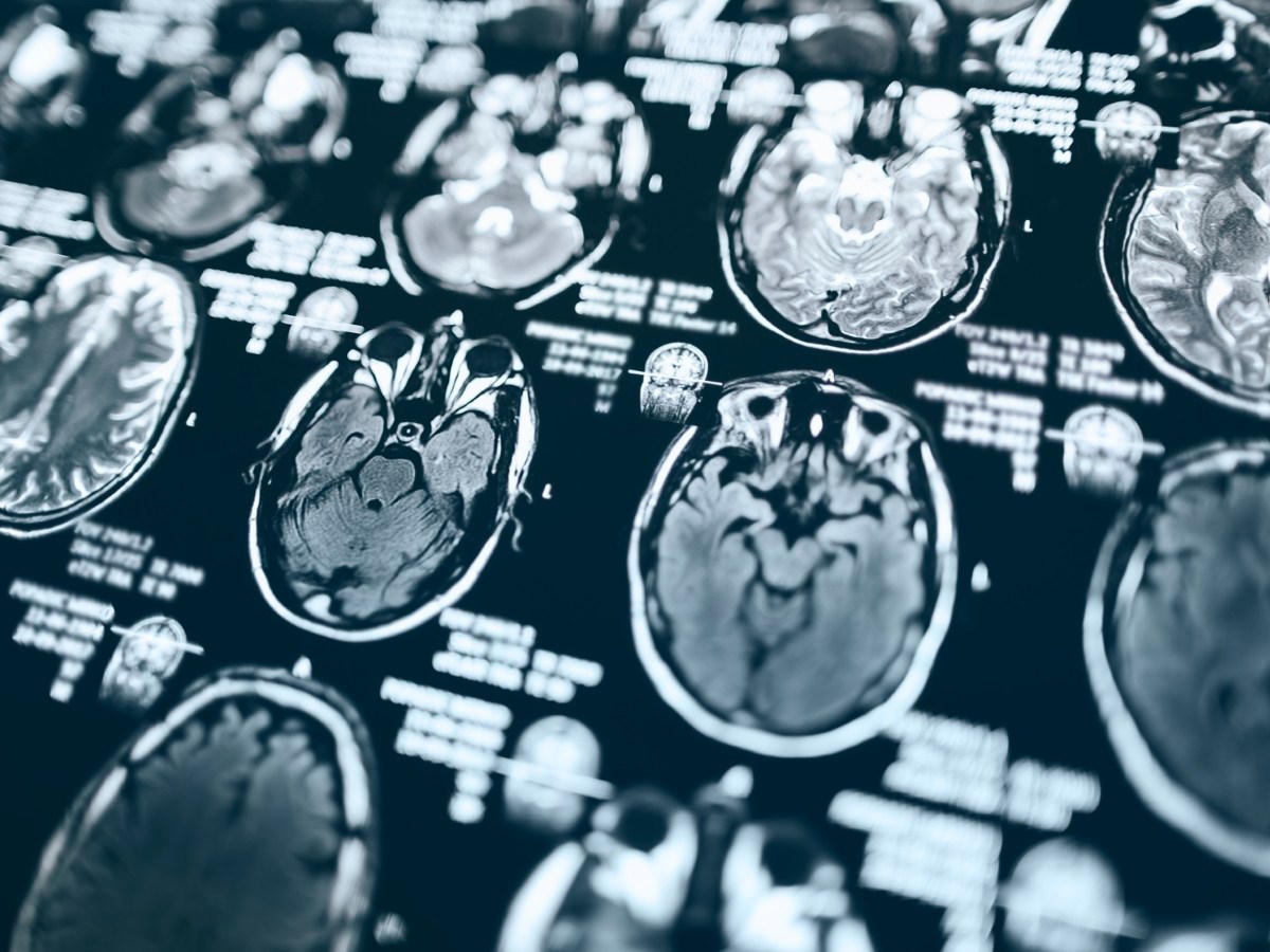 Cheap, Common Drug Linked To Far Lower Dementia Risk—But Only For Some